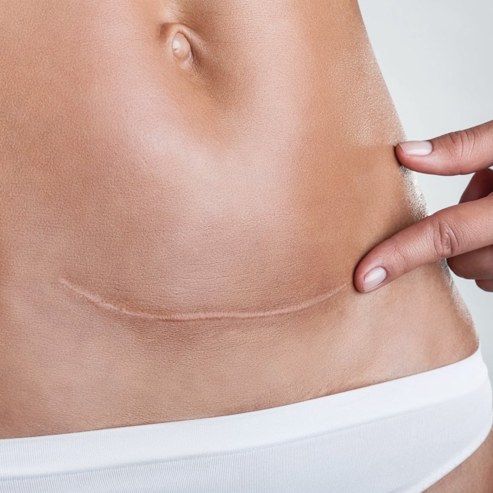 Browse Scar Reduction Scar Reduction
