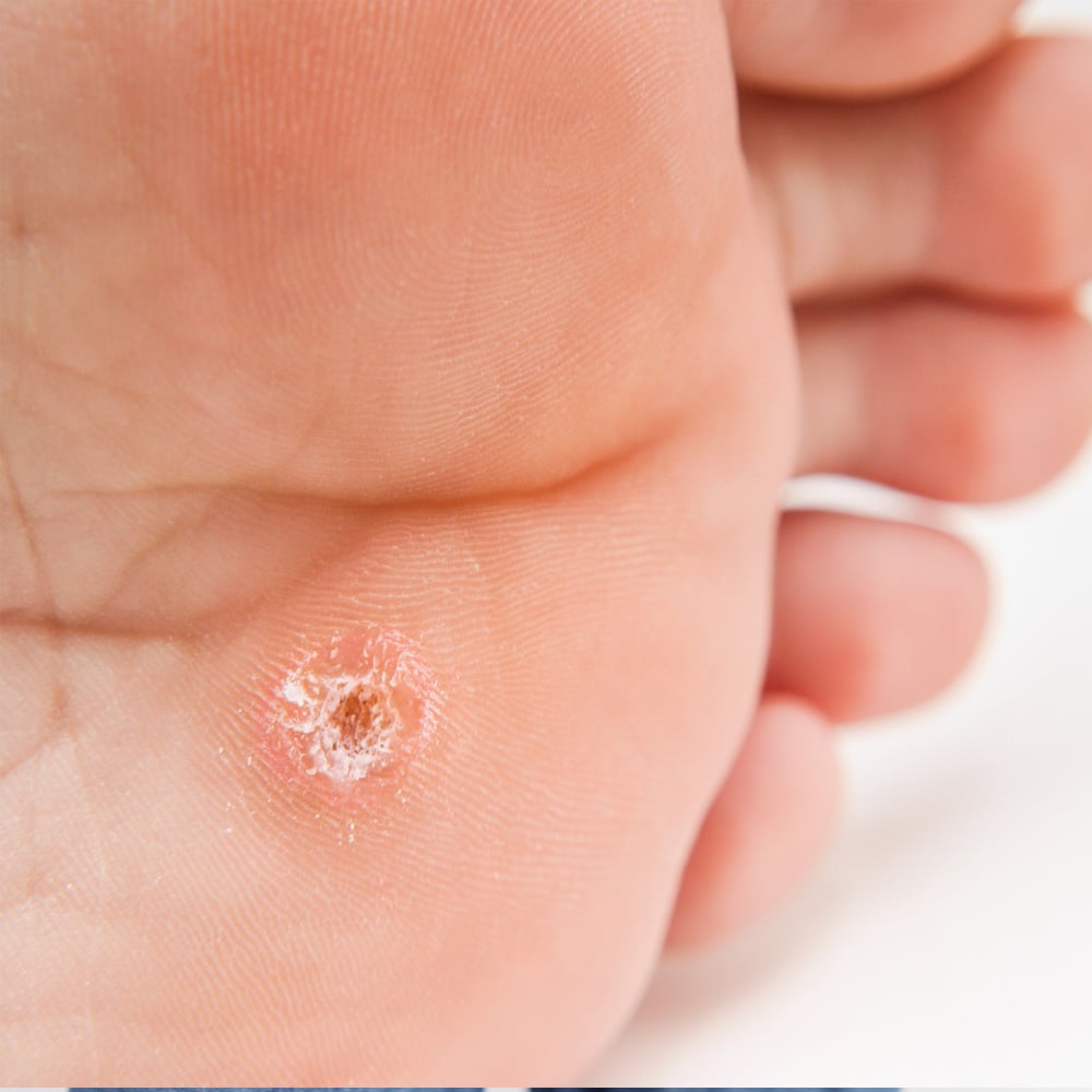 Browse Warts & Verrucas Warts & Verrucas