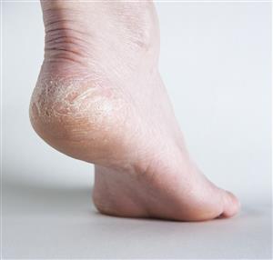 Browse Cracked & Dry Skin Cracked & Dry Skin