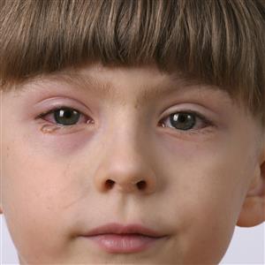 Browse Eye Infections Eye Infections