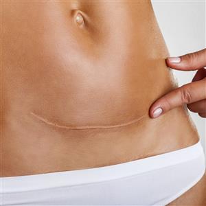 Browse Scars, Cellulite & Stretch Marks Scars, Cellulite & Stretch Marks