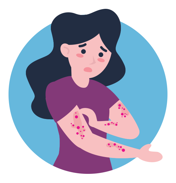 Illustration of a woman scratching at sore and itchy patches of eczema which cover both of her arms