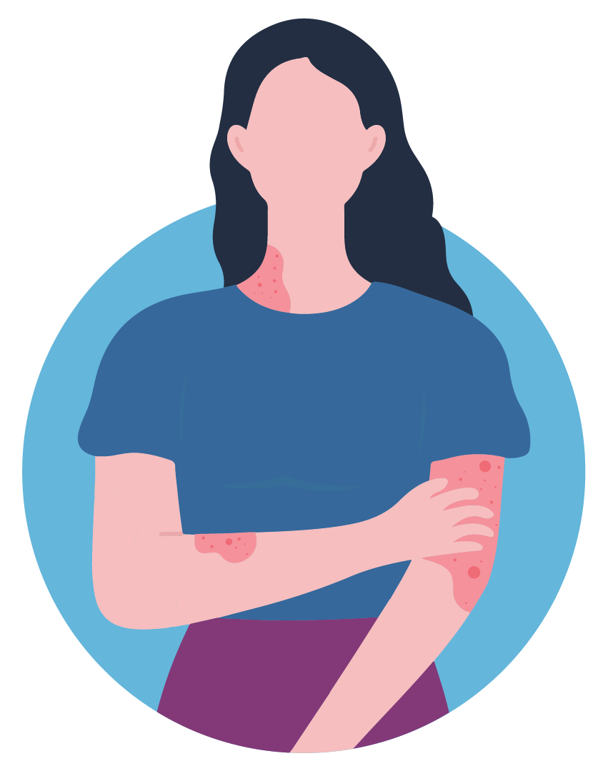 Illustration of a woman who has irritated red patches of psoriasis on her arms and neck, she is itching a patch on her left arm with her right hand