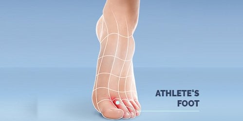 ATHLETE'S FOOT TREATMENTS