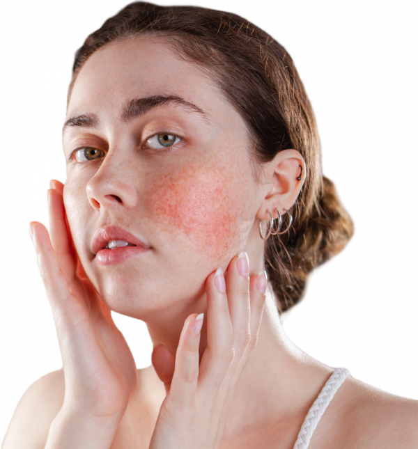 Start Your Rosacea Prescription Consultation | Chemist4U